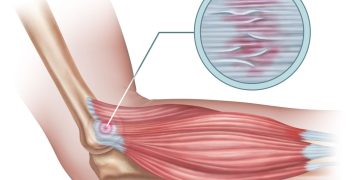 Lateral Epicondylitis (Tennis Elbow)