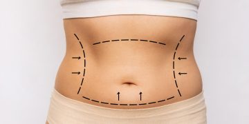 Liposuction (Liposakşın) Cerrahileri ve Lenf Masajı